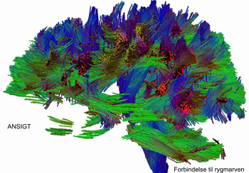 Ph.d. Tim Bjørn Dyrbys hjerne, som den ser ud med traktografi