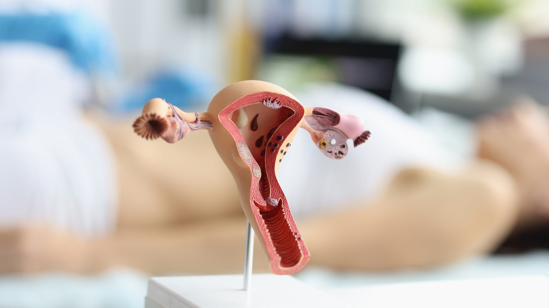 Model af livmoder foran en liggende kvinde, som får udført en ultralydsscanning